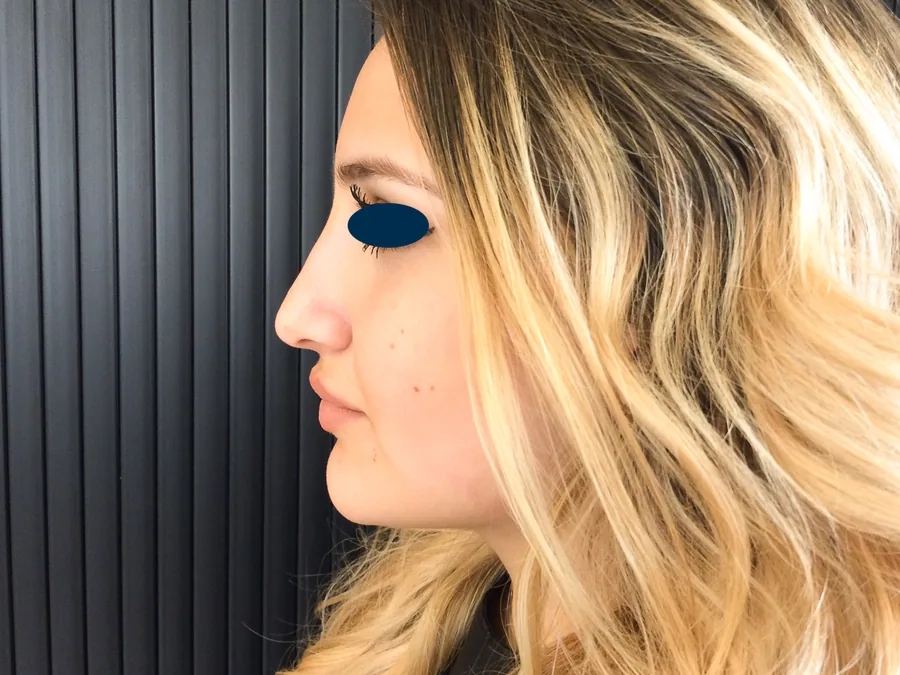 Photo après rhinoplastie - Dr Pulvermacker, Paris