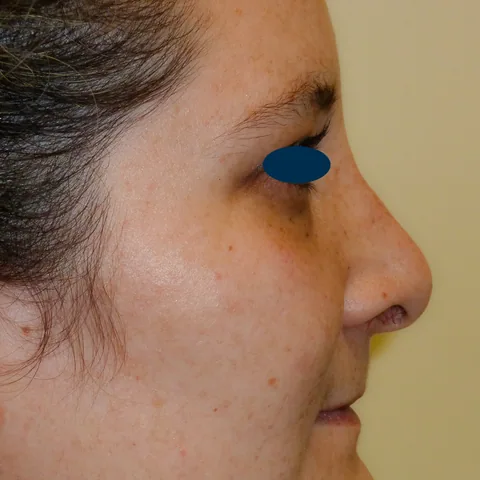 Photo après rhinoplastie - Dr Pulvermacker, Paris