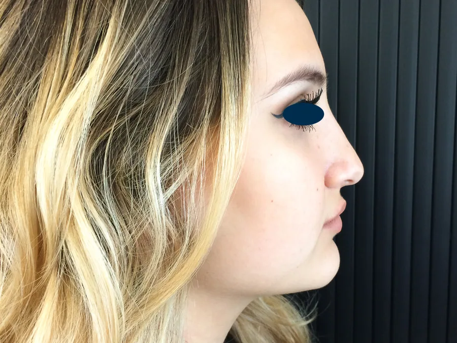 Photo après rhinoplastie - Dr Pulvermacker, Paris