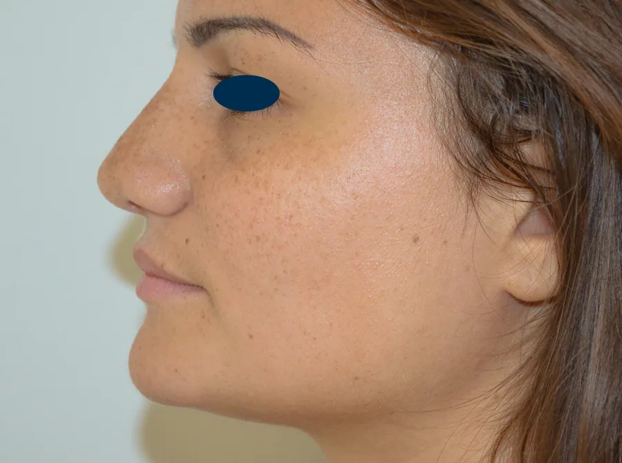 Photo après rhinoplastie - Dr Pulvermacker, Paris