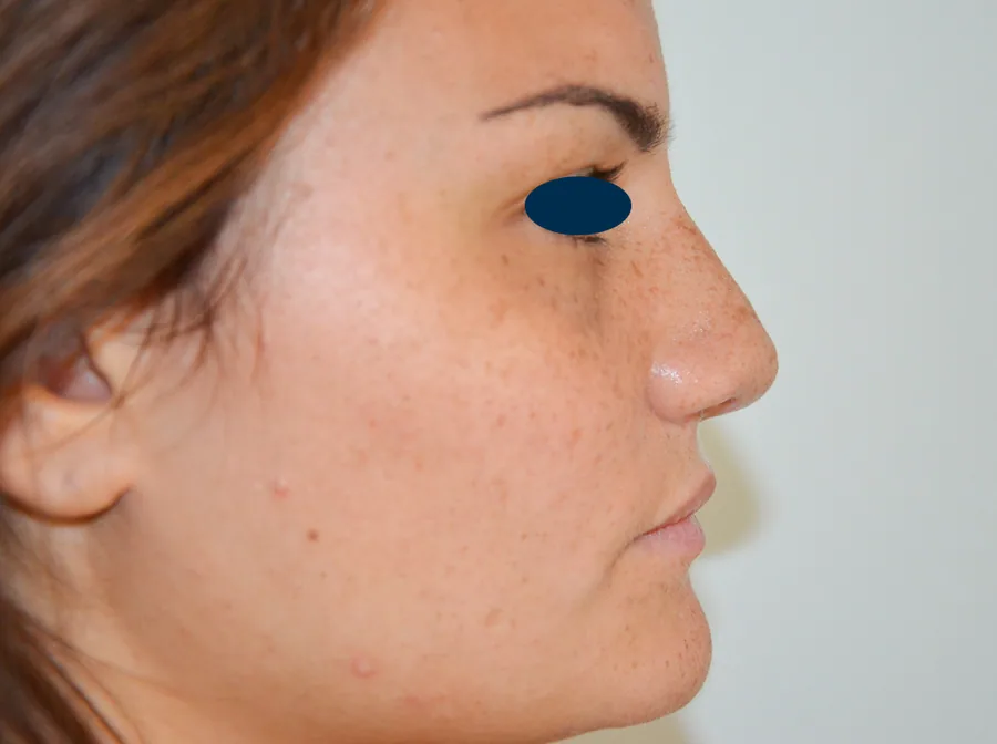 Photo après rhinoplastie - Dr Pulvermacker, Paris