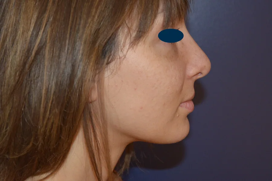 Photo après rhinoplastie - Dr Pulvermacker, Paris