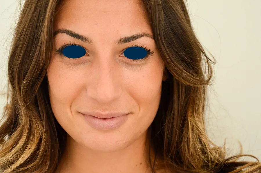 Photo après rhinoplastie - Dr Pulvermacker, Paris
