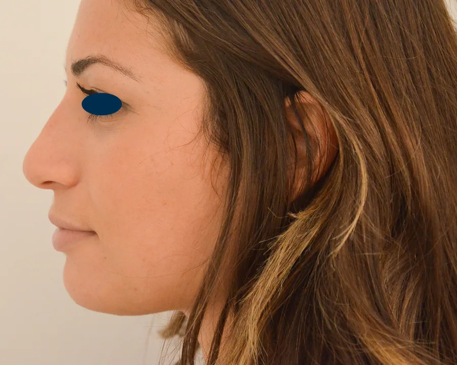 Photo après rhinoplastie - Dr Pulvermacker, Paris