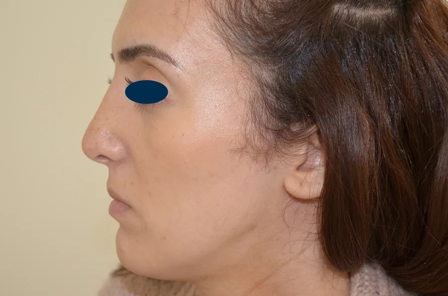 Photo après rhinoplastie - Dr Pulvermacker, Paris
