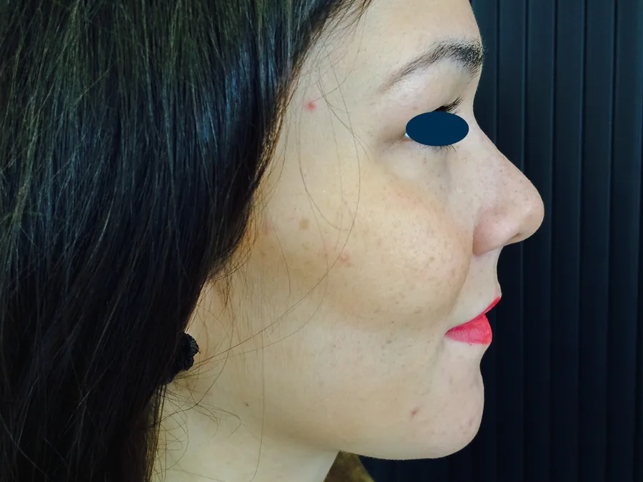Photo après rhinoplastie - Dr Pulvermacker, Paris