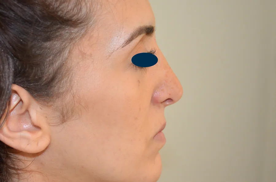 Photo après rhinoplastie - Dr Pulvermacker, Paris