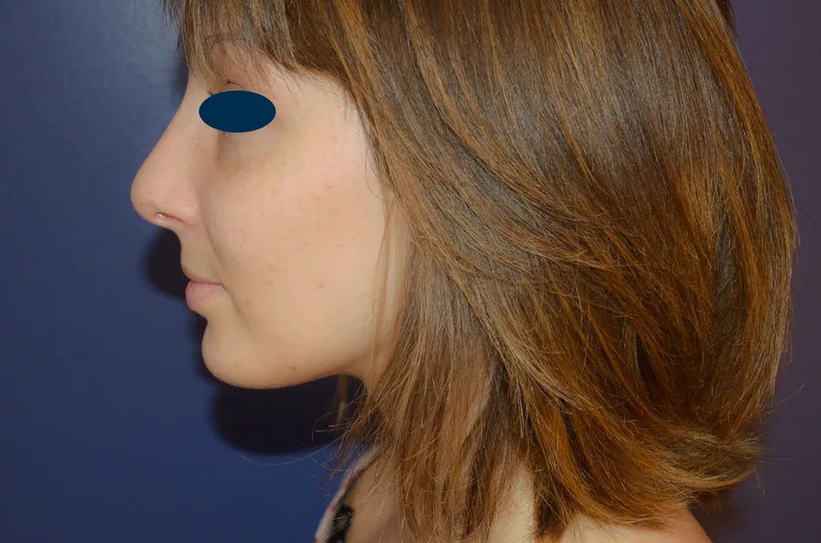 Photo après rhinoplastie - Dr Pulvermacker, Paris