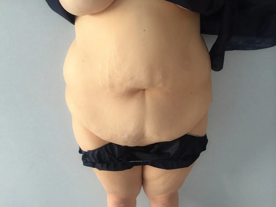 Photo avant abdominoplastie - Dr Pulvermacker, Paris