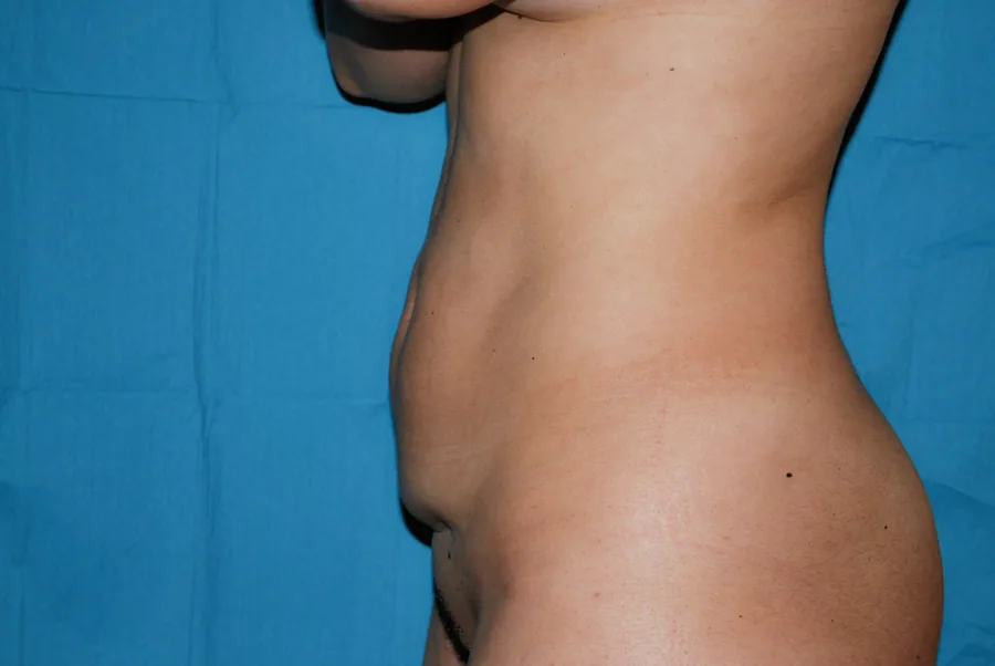 Photo avant abdominoplastie - Dr Pulvermacker, Paris