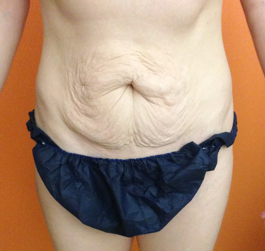 Photo avant abdominoplastie - Dr Pulvermacker, Paris