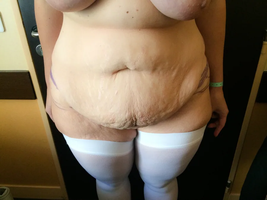 Photo avant abdominoplastie - Dr Pulvermacker, Paris