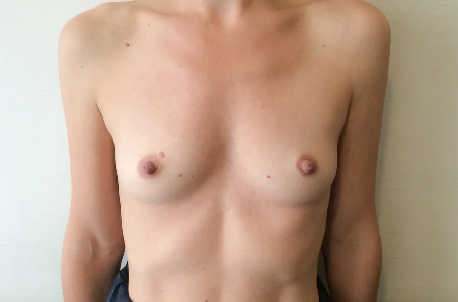 Photo avant augmentation mammaire - Dr Pulvermacker, Paris