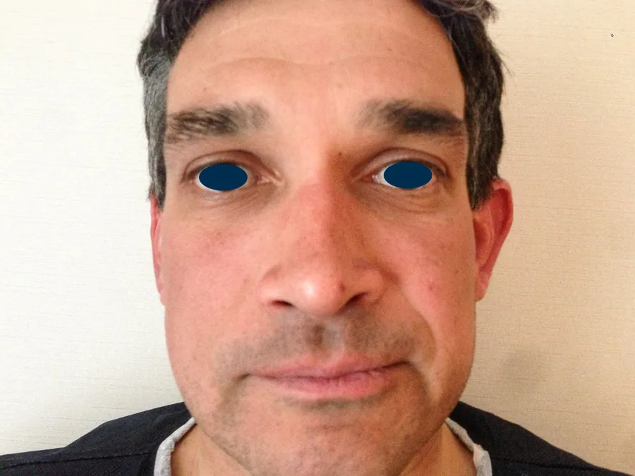 Photo avant chirurgie des oreilles - Dr Pulvermacker, Paris