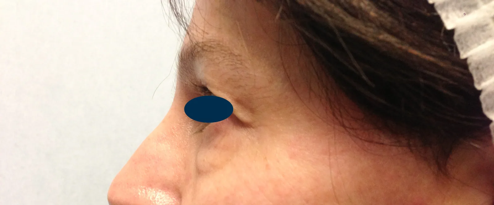 Photo avant chirurgie des paupières - Dr Pulvermacker, Paris