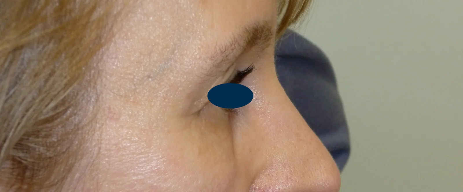 Photo avant chirurgie des paupières - Dr Pulvermacker, Paris