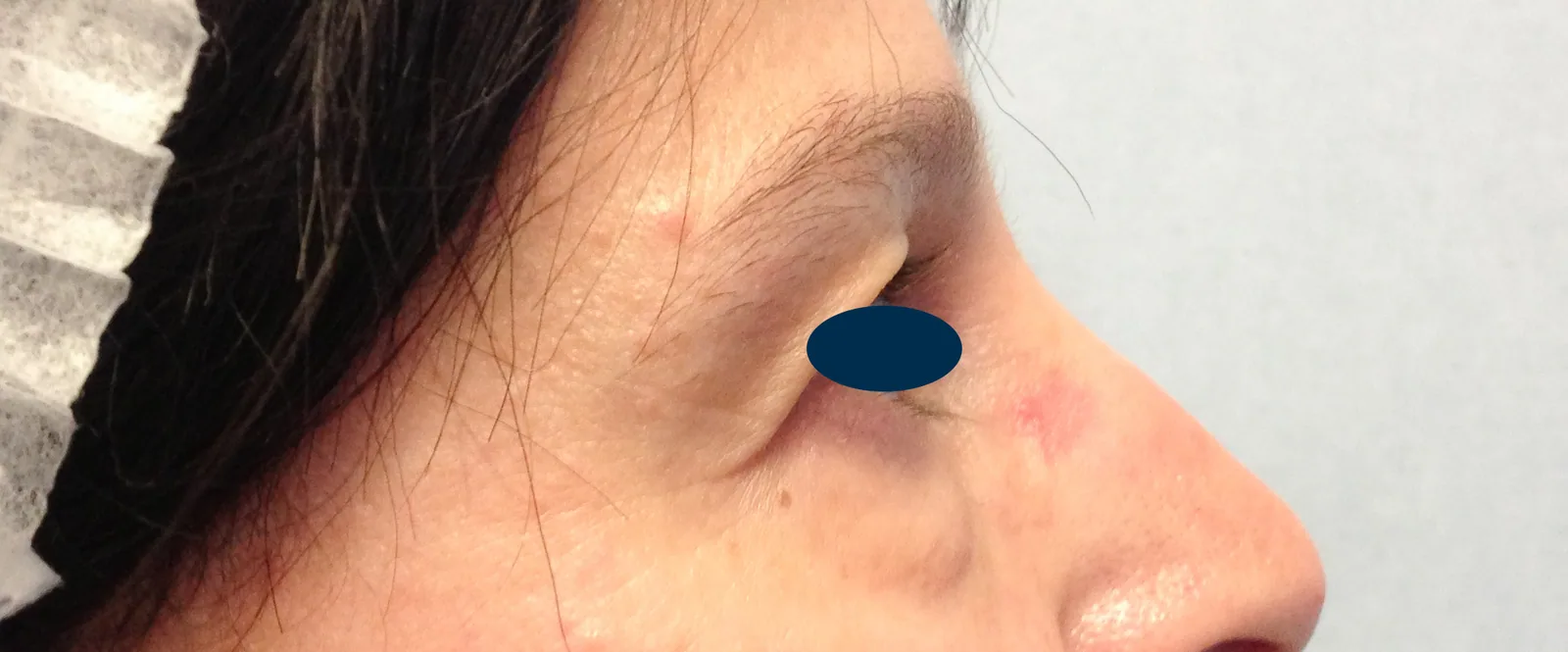 Photo avant chirurgie des paupières - Dr Pulvermacker, Paris