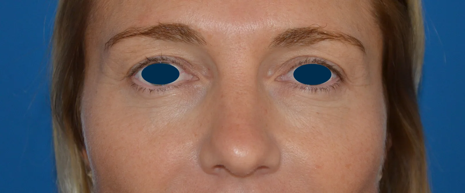 Photo avant chirurgie des paupières - Dr Pulvermacker, Paris