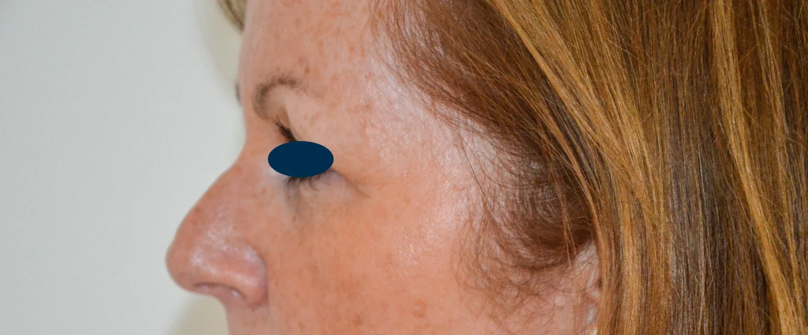 Photo avant chirurgie des paupières - Dr Pulvermacker, Paris
