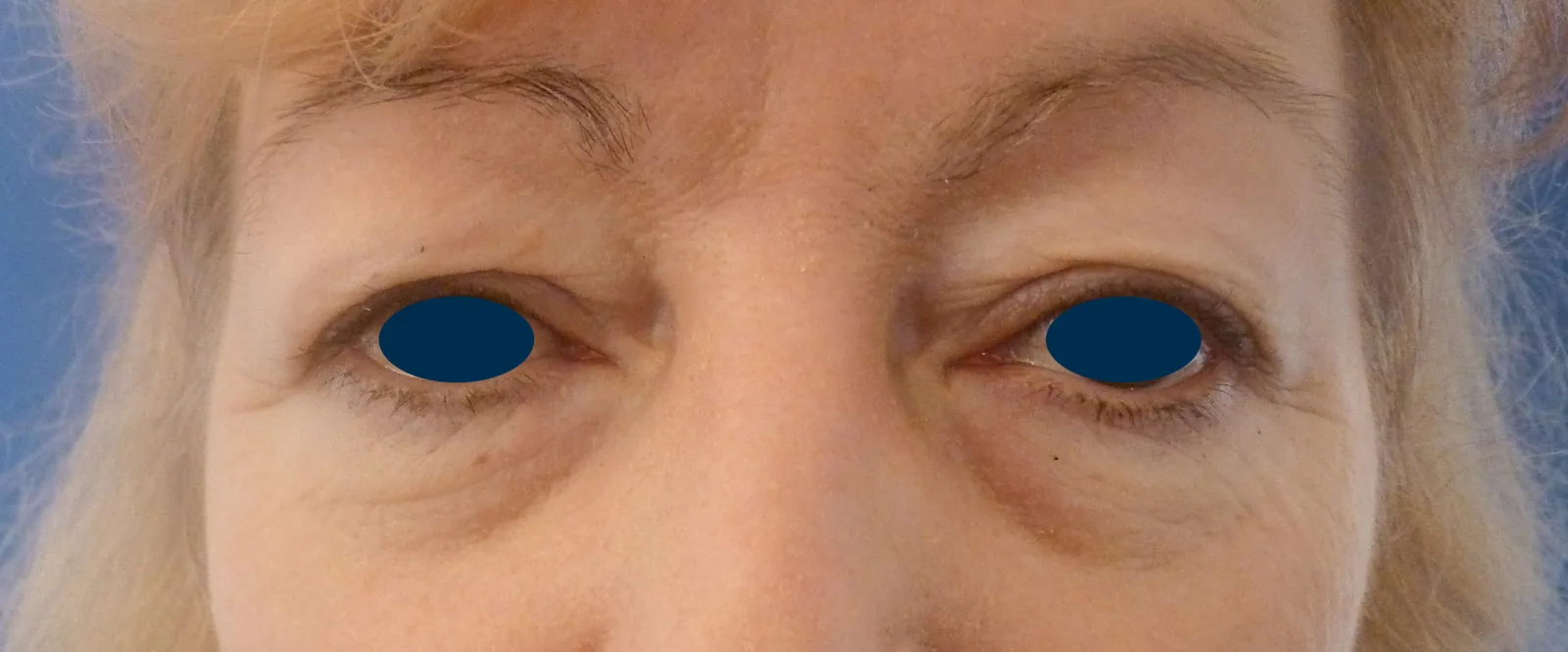 Photo avant chirurgie des paupières - Dr Pulvermacker, Paris