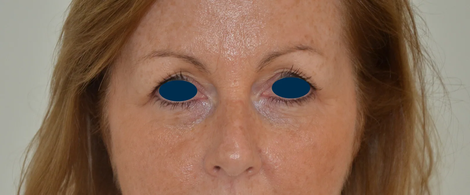 Photo avant chirurgie des paupières - Dr Pulvermacker, Paris