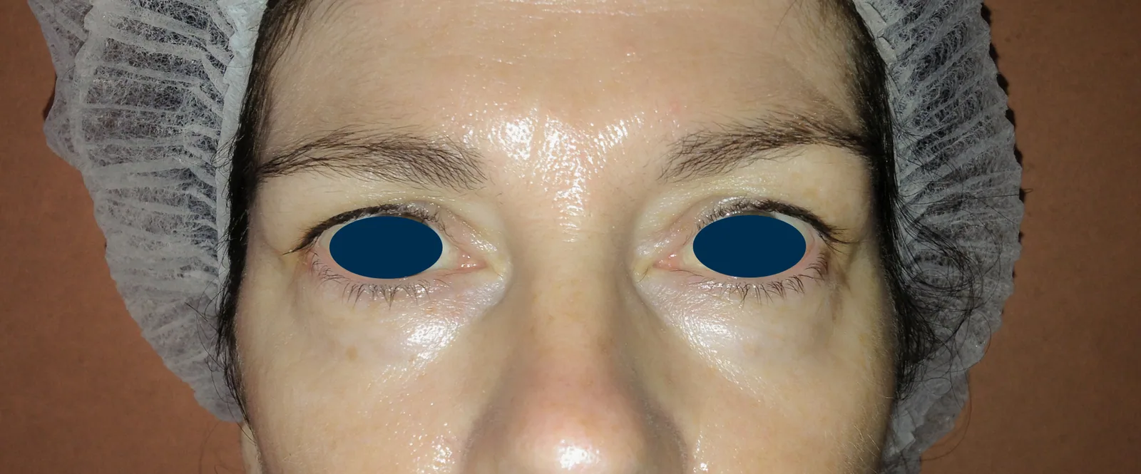 Photo avant chirurgie des paupières - Dr Pulvermacker, Paris