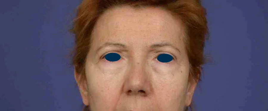 Photo avant chirurgie des paupières - Dr Pulvermacker, Paris
