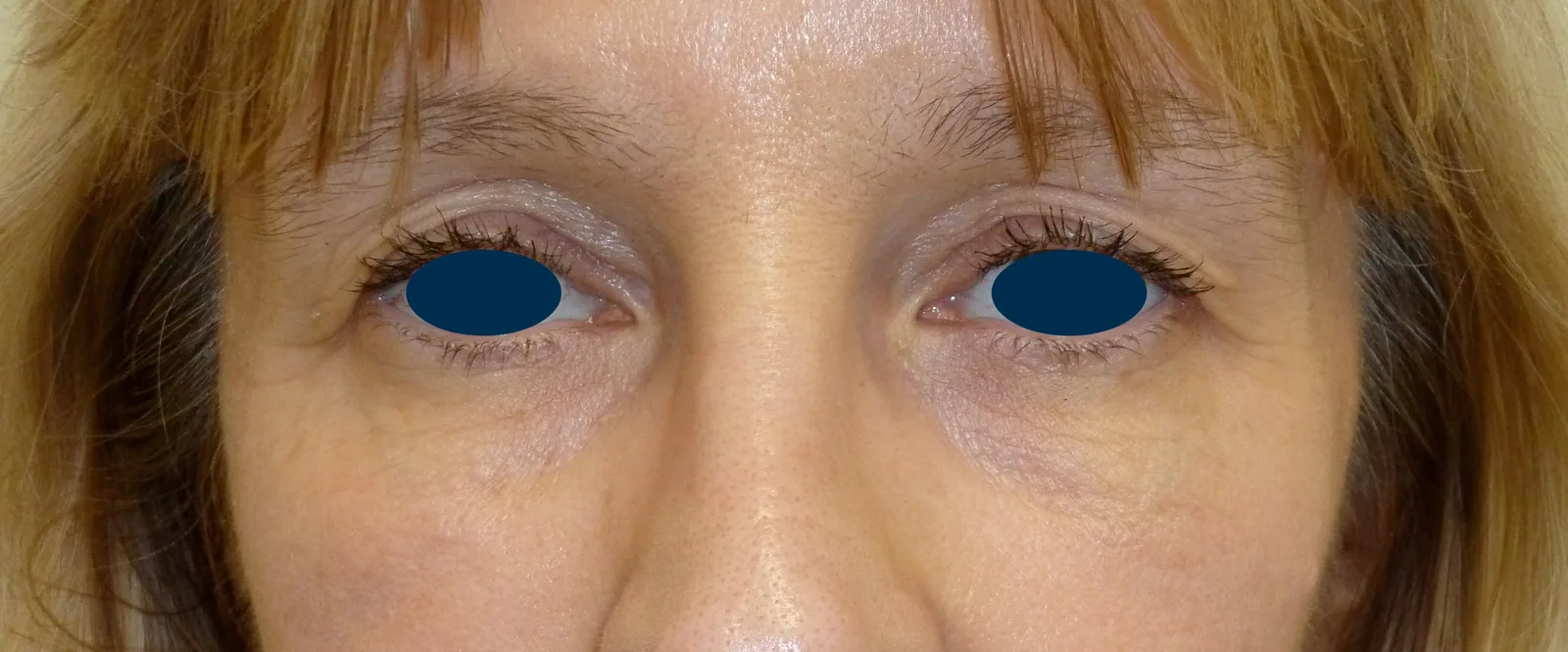 Photo avant chirurgie des paupières - Dr Pulvermacker, Paris