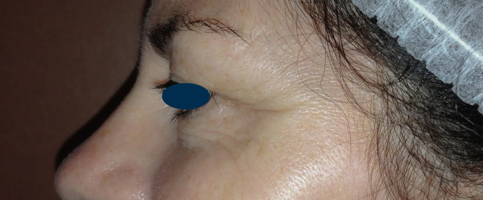 Photo avant chirurgie des paupières - Dr Pulvermacker, Paris