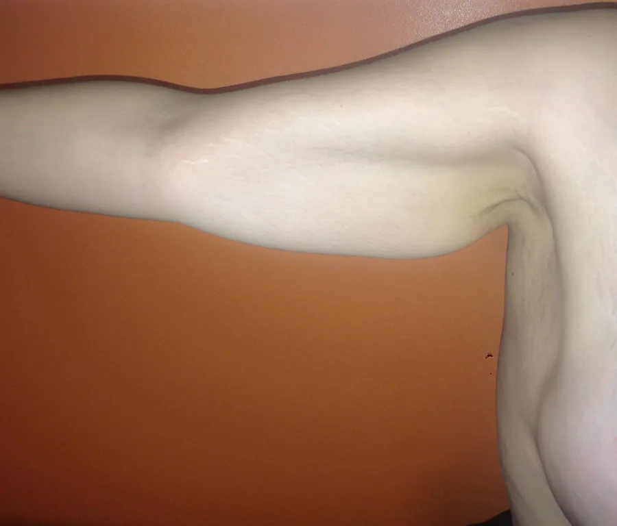 Photo avant lifting des bras - Dr Pulvermacker, Paris