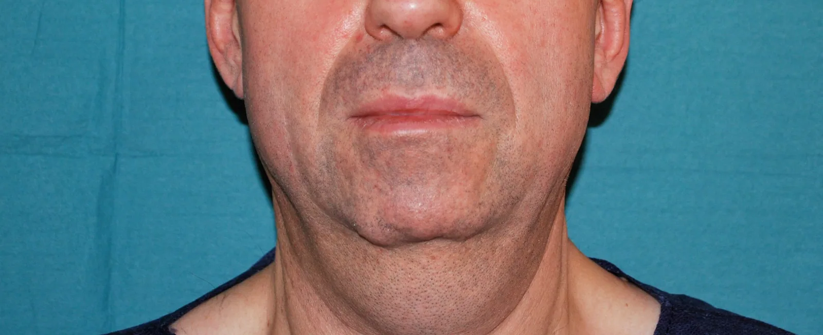 Photo avant lifting du visage - Dr Pulvermacker, Paris