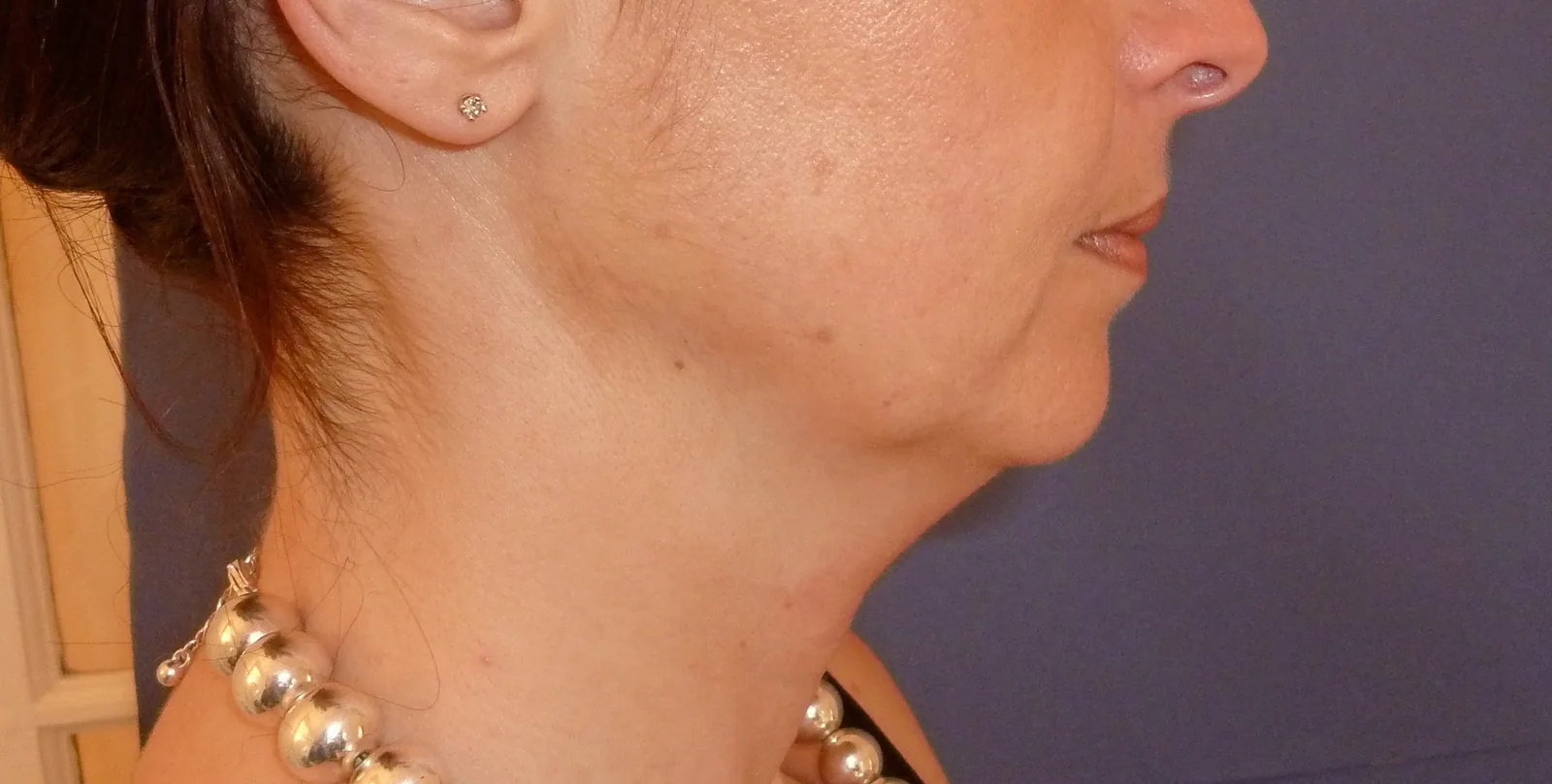 Photo avant lifting du visage - Dr Pulvermacker, Paris