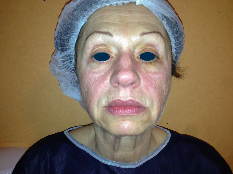 Photo avant lifting du visage - Dr Pulvermacker, Paris