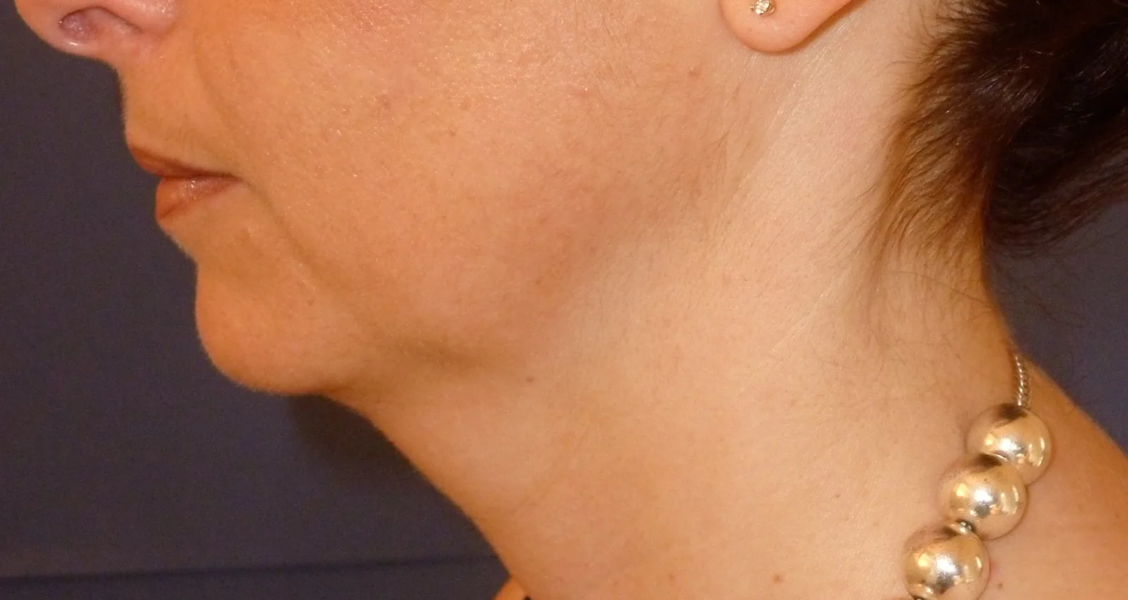 Photo avant lifting du visage - Dr Pulvermacker, Paris