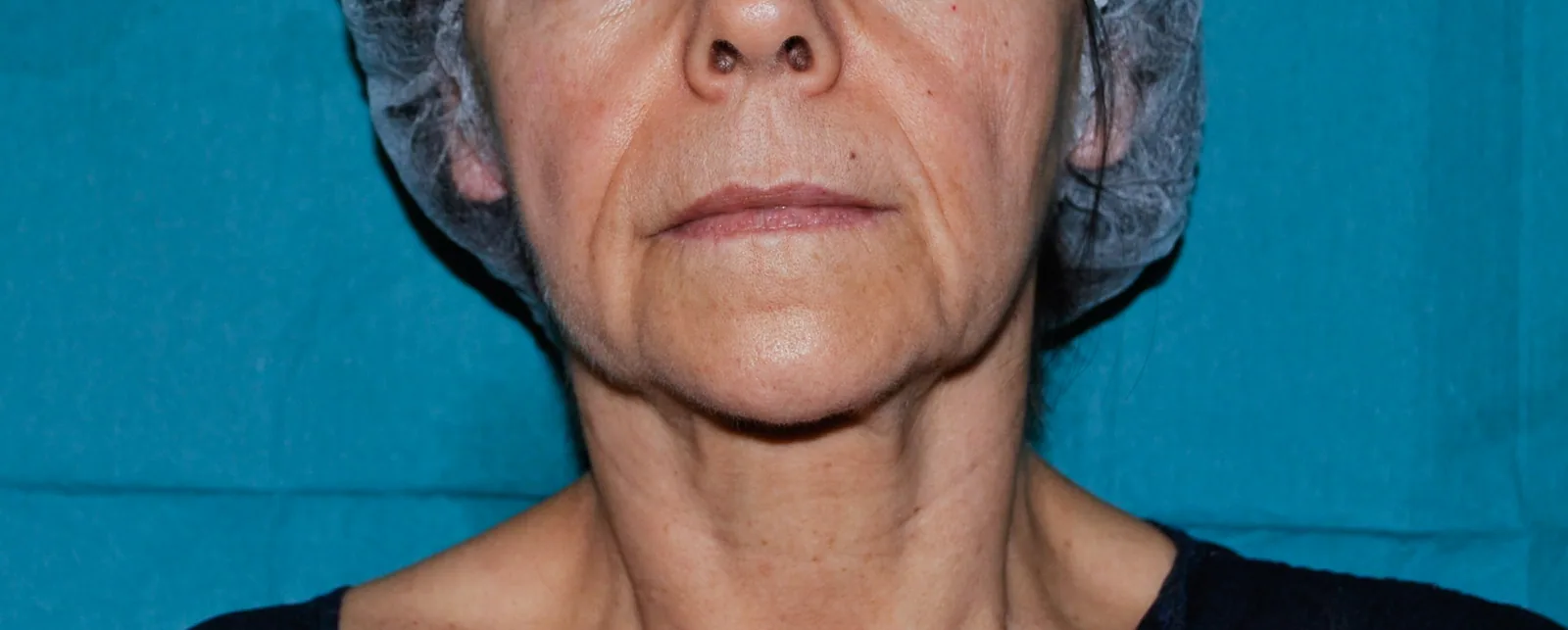 Photo avant lifting du visage - Dr Pulvermacker, Paris