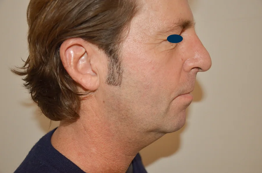 Photo avant lifting du visage - Dr Pulvermacker, Paris