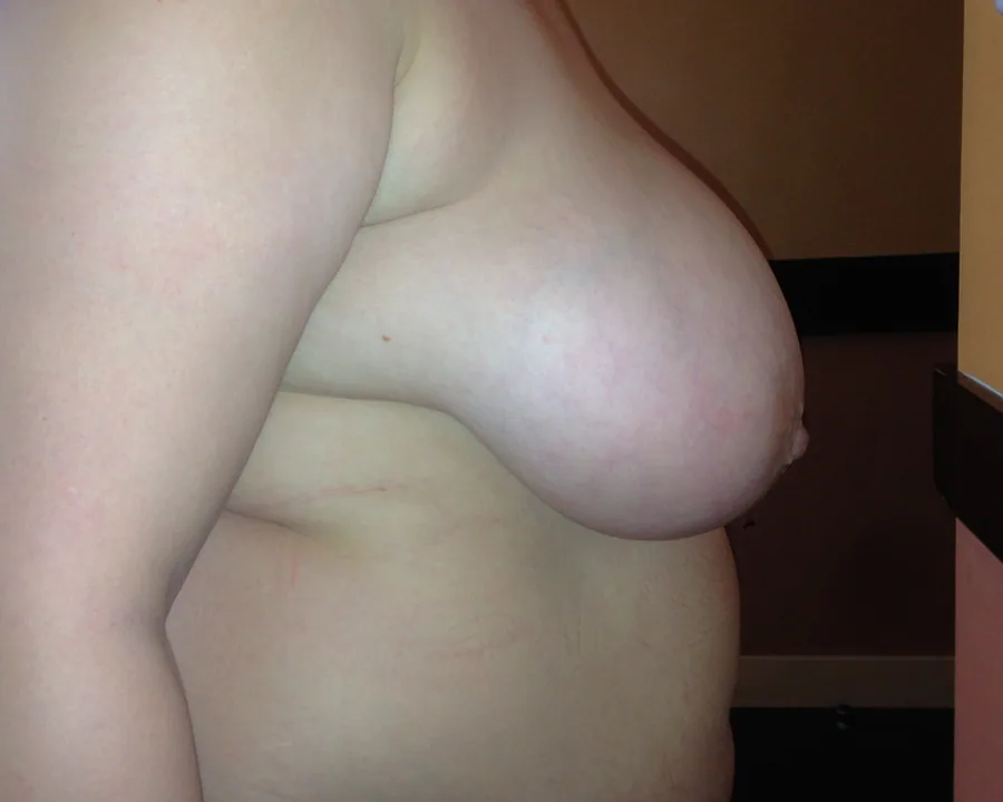 Photo avant réduction mammaire - Dr Pulvermacker, Paris