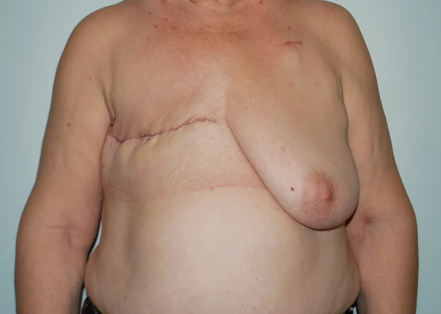 Photo avant reconstruction mammaire - Dr Pulvermacker, Paris