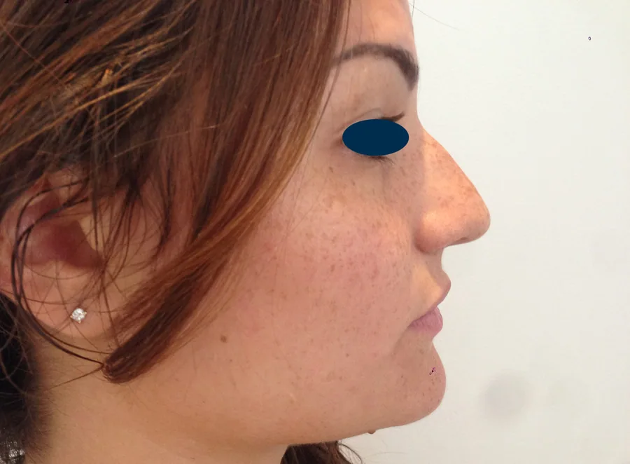 Photo avant rhinoplastie - Dr Pulvermacker, Paris