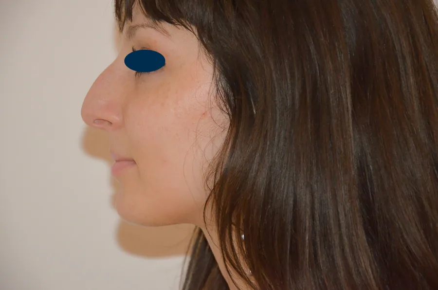 Photo avant rhinoplastie - Dr Pulvermacker, Paris