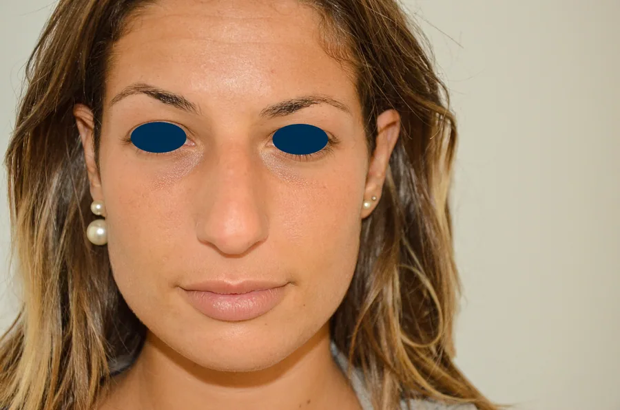 Photo avant rhinoplastie - Dr Pulvermacker, Paris