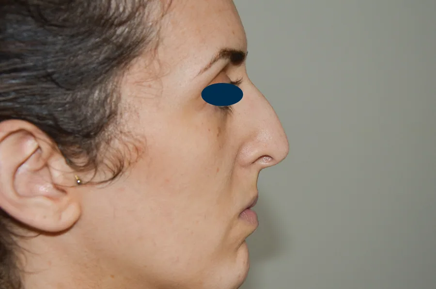 Photo avant rhinoplastie - Dr Pulvermacker, Paris