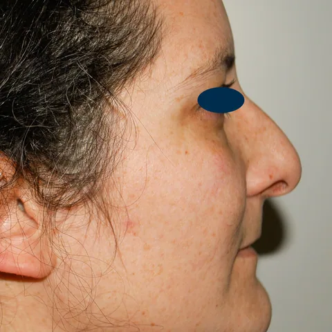 Photo avant rhinoplastie - Dr Pulvermacker, Paris