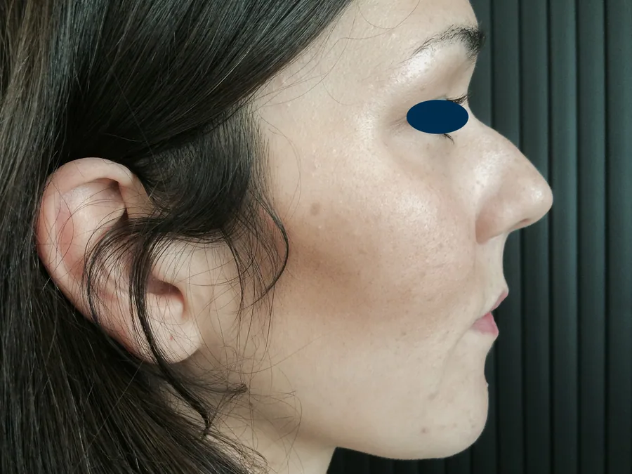 Photo avant rhinoplastie - Dr Pulvermacker, Paris