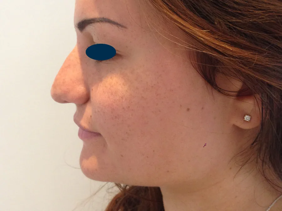 Photo avant rhinoplastie - Dr Pulvermacker, Paris