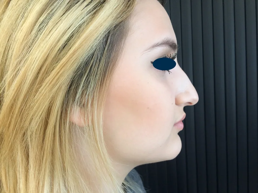 Photo avant rhinoplastie - Dr Pulvermacker, Paris