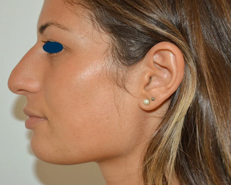 Photo avant rhinoplastie - Dr Pulvermacker, Paris