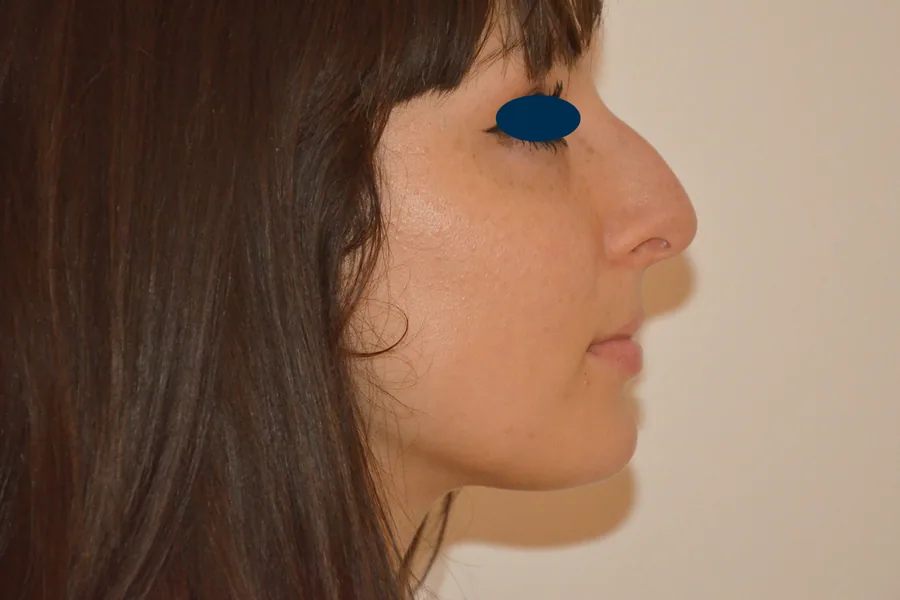 Photo avant rhinoplastie - Dr Pulvermacker, Paris