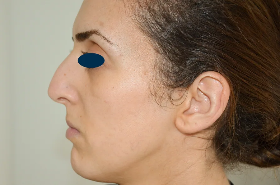 Photo avant rhinoplastie - Dr Pulvermacker, Paris