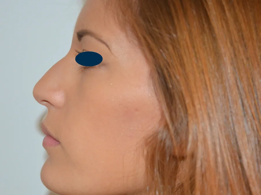 Photo avant rhinoplastie - Dr Pulvermacker, Paris
